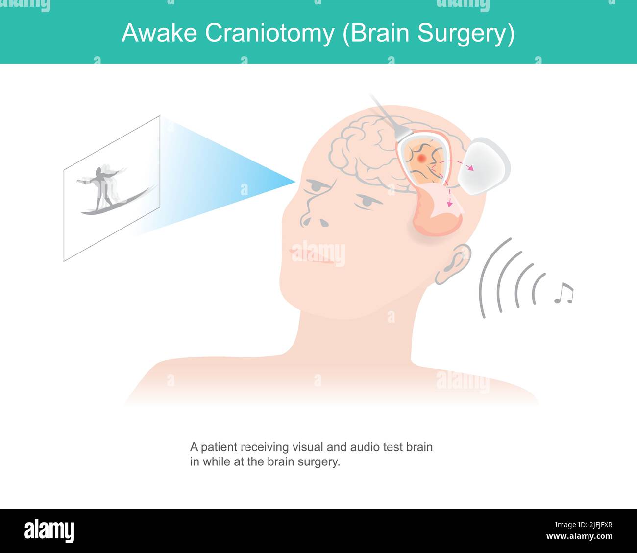 Craneotomía despierta. Un paciente que recibe pruebas visuales y sonoras del cerebro mientras se realiza una cirugía cerebral. Ilustración del Vector