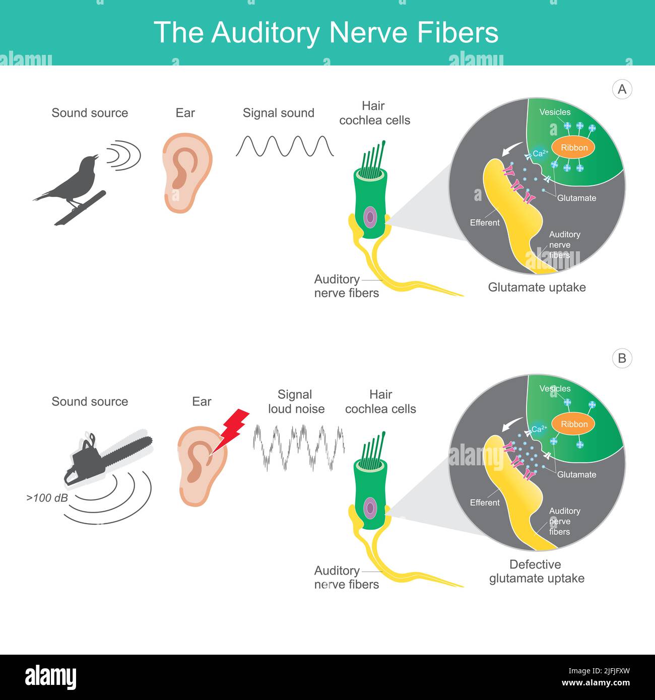 Las fibras del nervio auditivo, la fuente del sonido de la comparación 2 tipos que se envía el sonido de la señal a las fibras del nervio auditivo que afectan el cerebro humano. Ilustración del Vector