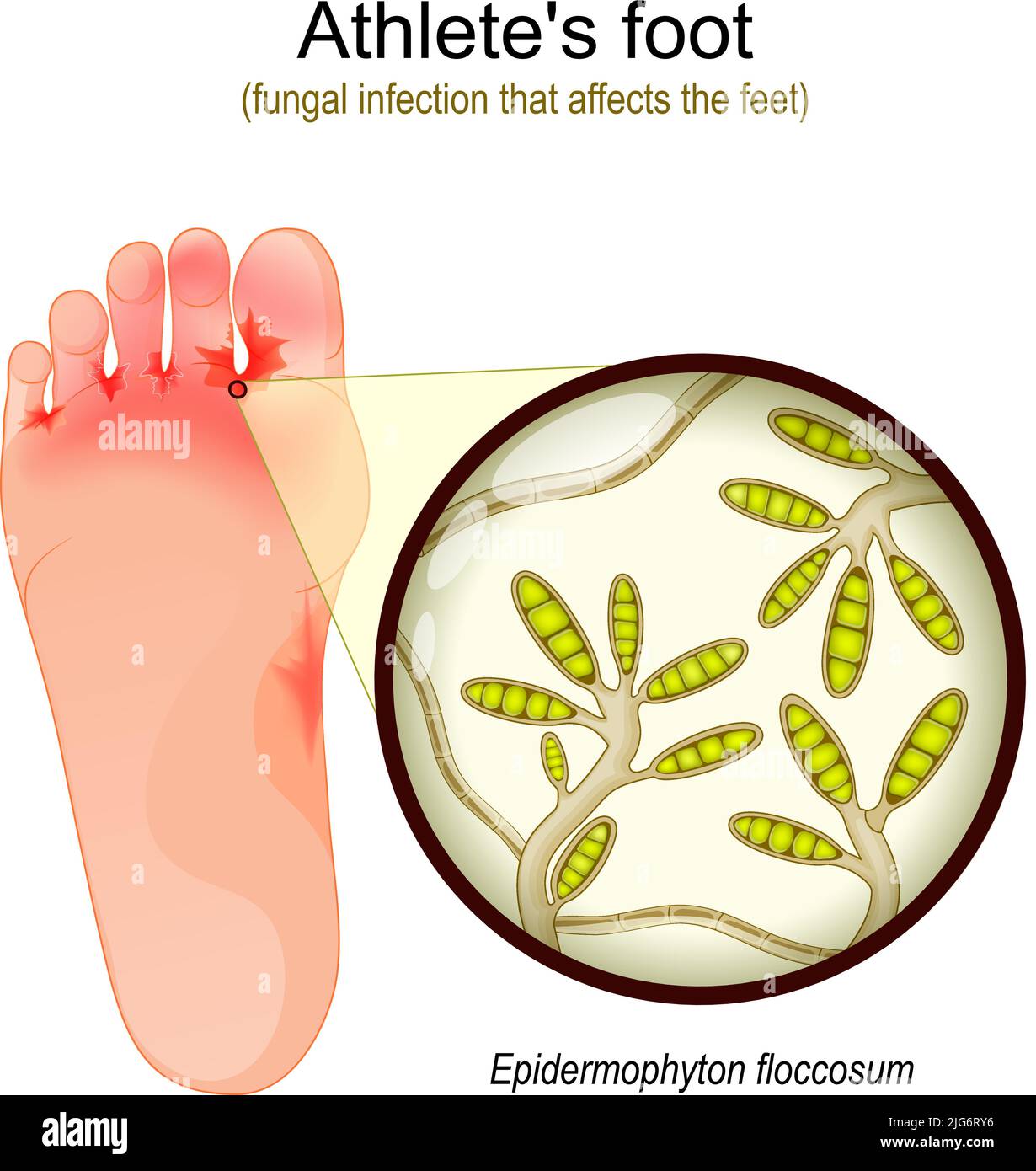 Infección micótica que afecta los pies. Primer plano de la levadura que causa enfermedad infecciosa de la piel. Epidermophyton flocosum. Vector illu Ilustración del Vector