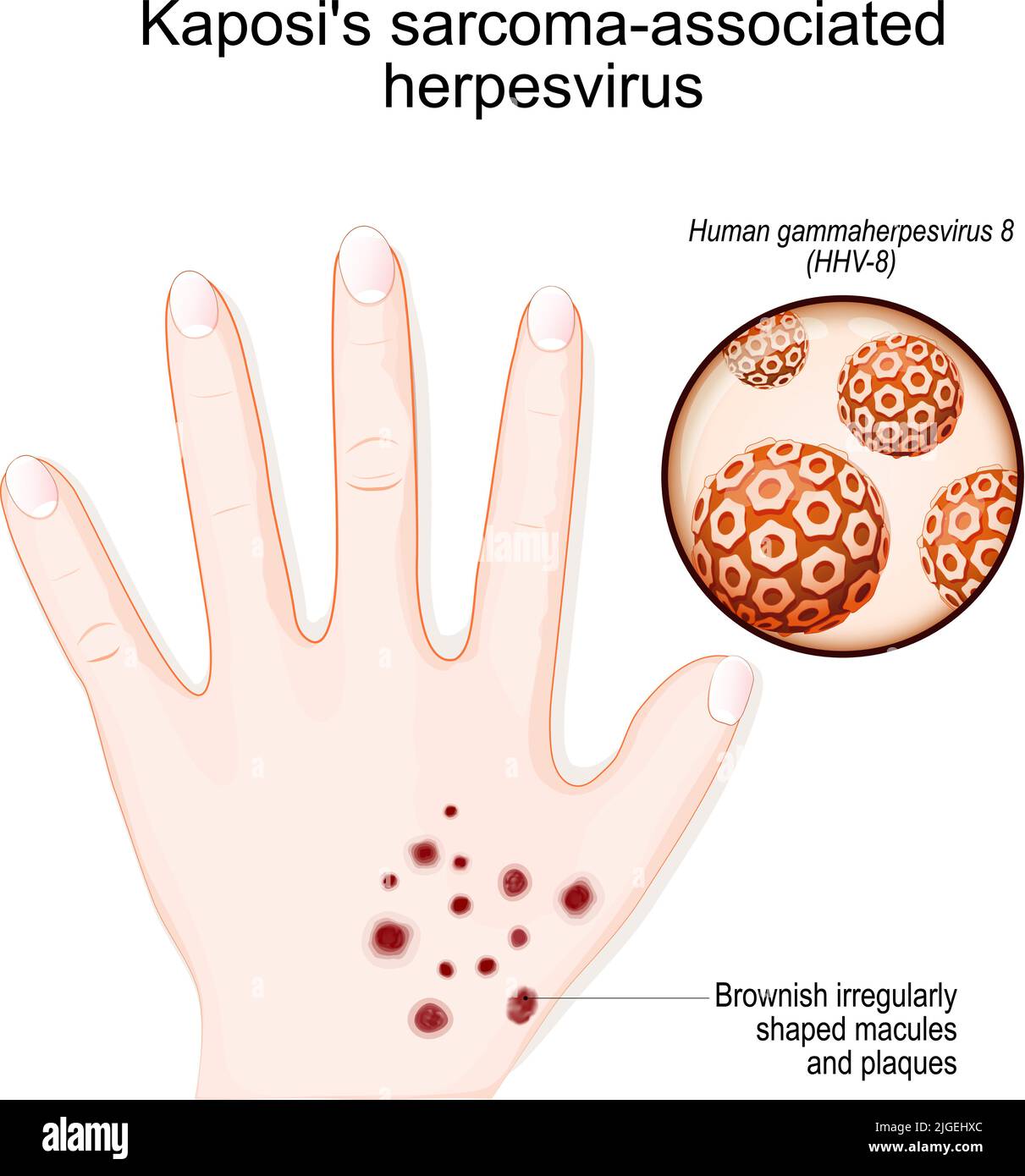 Herpesvirus asociado al sarcoma de Kaposi. Mano humana con máculas y placas parduscas de forma irregular. Primer plano del virus de la gammaherpesvirus humano (HHV-8) Ilustración del Vector