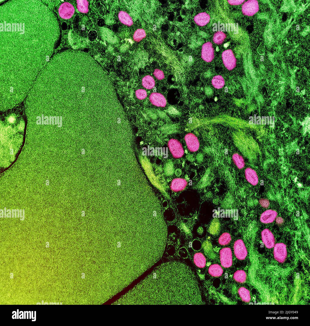 Viruela del simio. Micrografía electrónica de transmisión coloreada de partículas maduras del virus Nipah extracelular (rojo) cerca de la periferia de una célula VERO infectada (azul y verde). Imagen capturada en la Instalación Integrada de Investigación NIAID en Fort Detrick, Maryland. NIAID La viruela del simio es una enfermedad viral infecciosa que puede ocurrir en los seres humanos y en algunos otros animales.Los síntomas incluyen fiebre, ganglios linfáticos inflamados y una erupción que forma ampollas y luego costras. El tiempo transcurrido desde la exposición hasta el inicio de los síntomas varía de 5 a 21 días. La duración de los síntomas suele ser de 2 a 4 semanas. Foto de stock