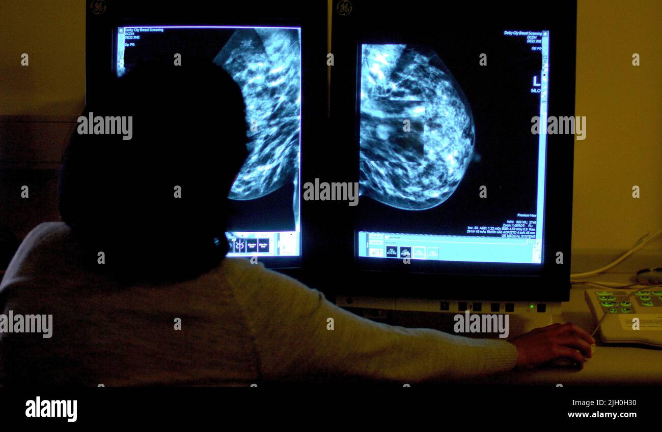 Foto de archivo con fecha 15/06/06 de un consultor que estudia una mamografía. Miles de pacientes con cáncer de mama se beneficiarán de dos nuevos medicamentos que estarán disponibles a través del NHS. Unas 3.000 mujeres se beneficiarán al año del medicamento Alpelisib, que prolonga la vida, anunció el NHS. Y 650 pacientes con un cierto tipo de cáncer de mama tendrán acceso a Trodelvy, que finalmente ha recibido la luz verde para el uso del NHS, a pesar de haber sido rechazados preliminarmente a principios de este año. Fecha de emisión: Jueves 14 de julio de 2022. Foto de stock