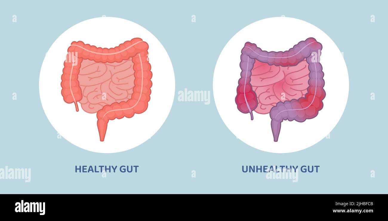 Comparación de intestino sano limpio y intestino inflamado no saludable Ilustración del Vector