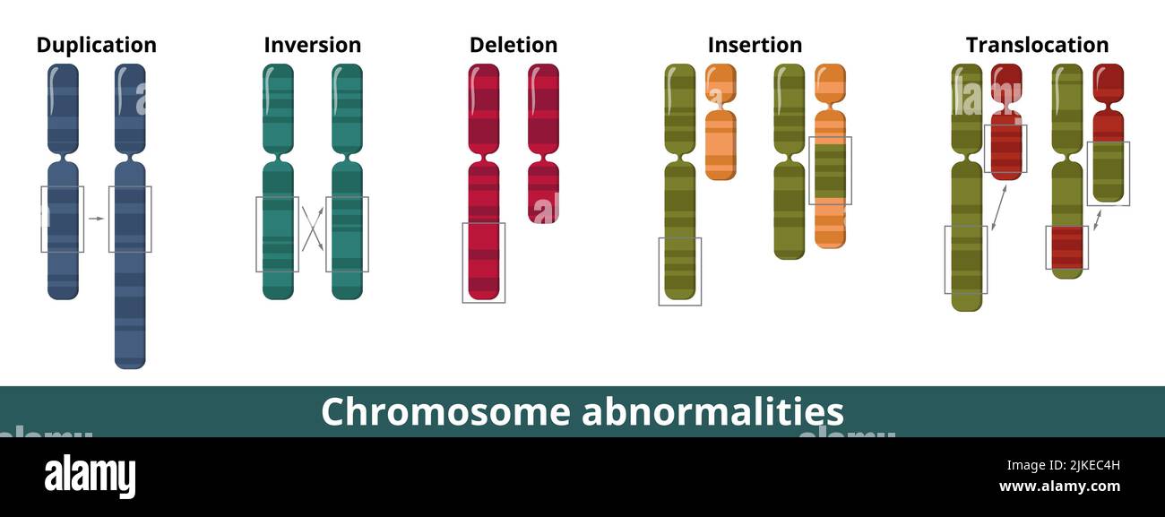Visualización de mutación o trastorno cromosómico común. Anormalidades numéricas o estructurales donde falta un ADN extra cromosómico. Ilustración del Vector