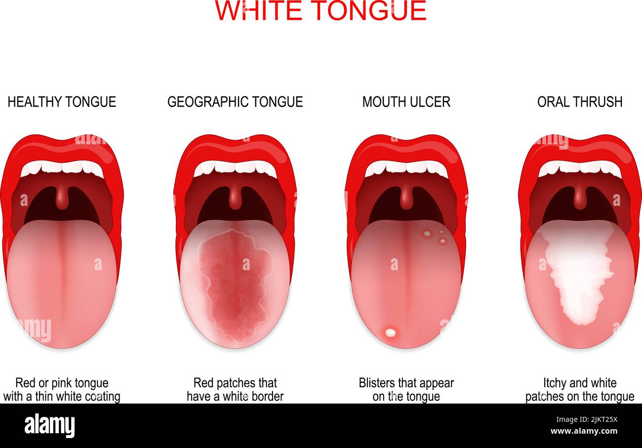 Lengua blanca o adolorida. Comparación de lengua sana y enfermedad oral: Lengua geográfica, úlcera bucal y candidiasis bucal. Póster Vector para uso médico Ilustración del Vector