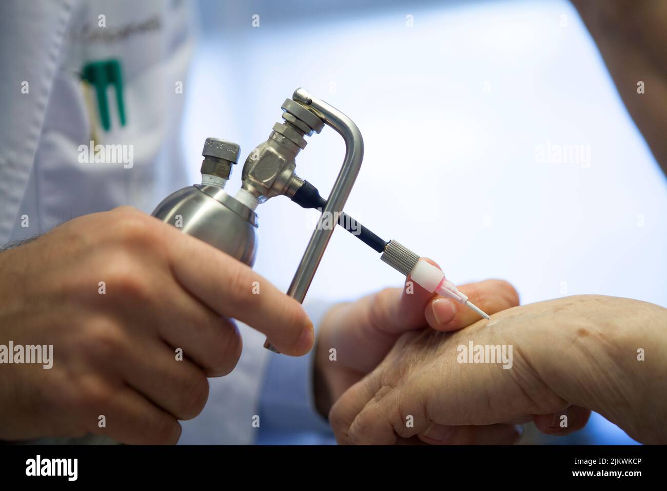 Dermatólogo aplicando nitrógeno líquido para reducir las manchas de edad. Foto de stock