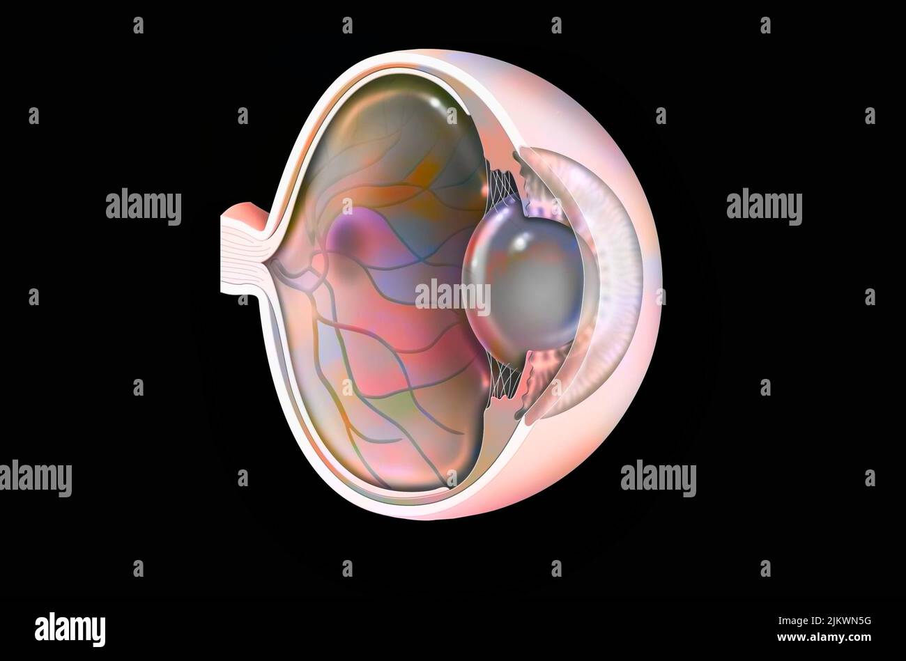 Ojo: Degeneración macular asociada a la edad (enfermedad degenerativa de la mácula). Foto de stock