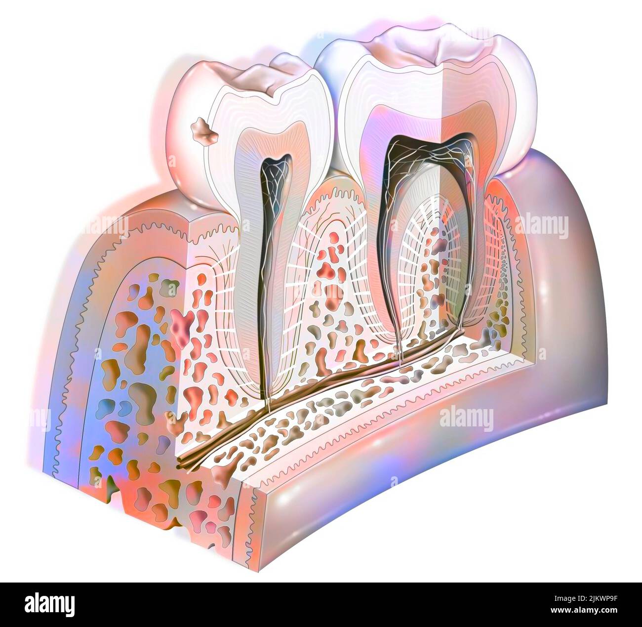 Placa dental: Primera etapa de caries. Foto de stock