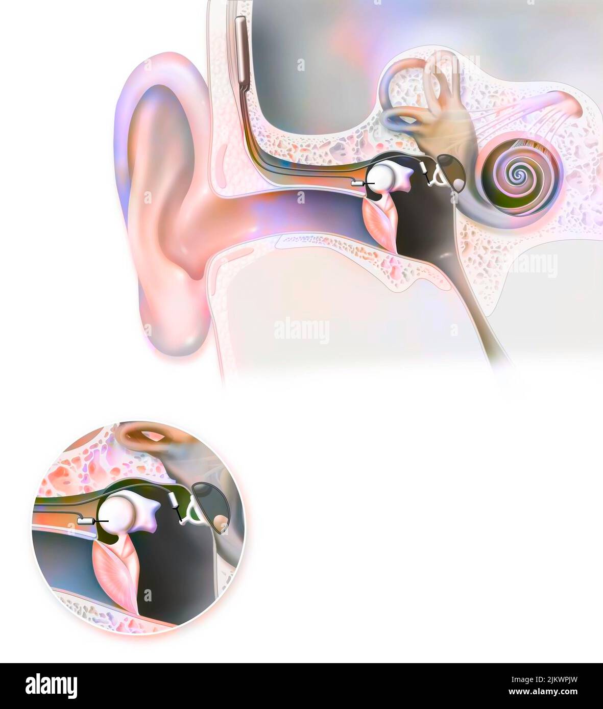 Oído: Audífono (ESTIME) implantable en el oído interno. Foto de stock