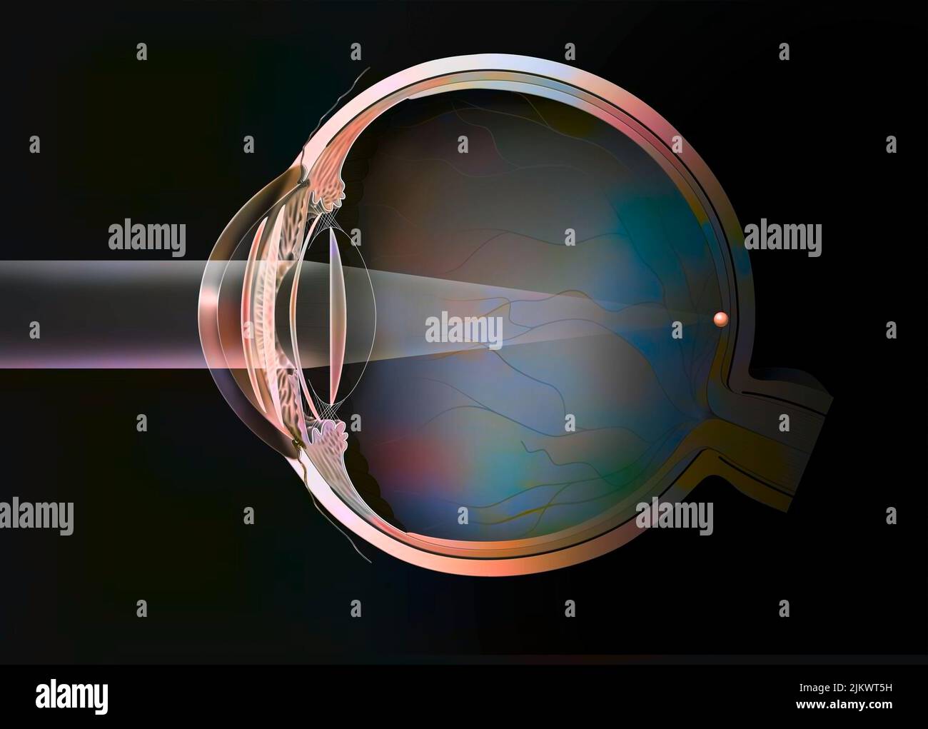 Lente intraocular fáquica fotografías e imágenes de alta resolución - Alamy