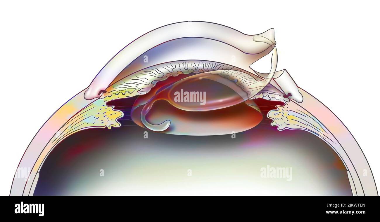 Ojo: Colocación de un implante intraocular para el tratamiento de cataratas. Foto de stock