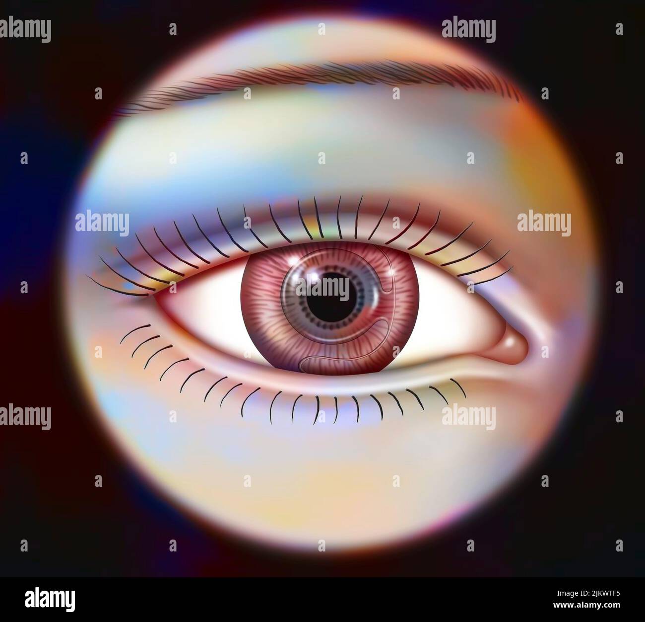 Implante intraocular sale