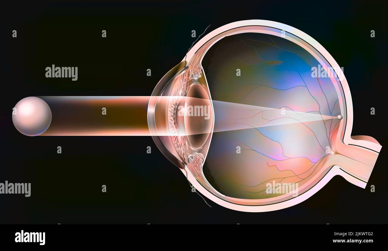 Visión normal en un ojo sano La imagen se forma en la retina