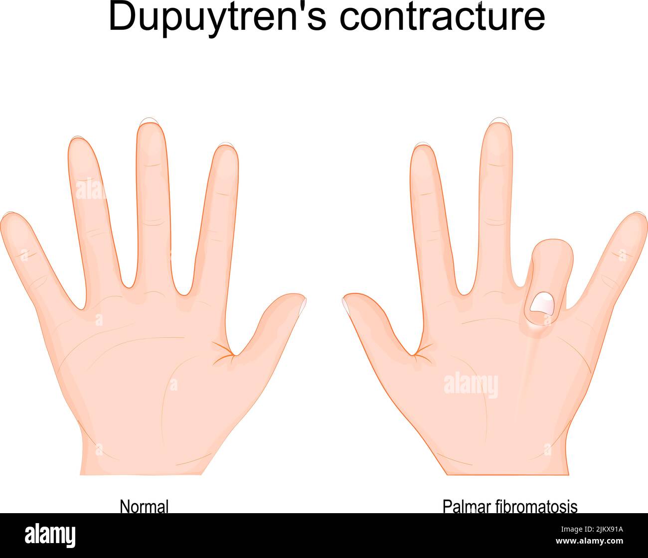 Contractura de Dupuytren. Comparación y diferencia entre una mano sana y la enfermedad de Dupuytren en la mano izquierda. Dedo que se dobla hacia la palma. Vector Ilustración del Vector