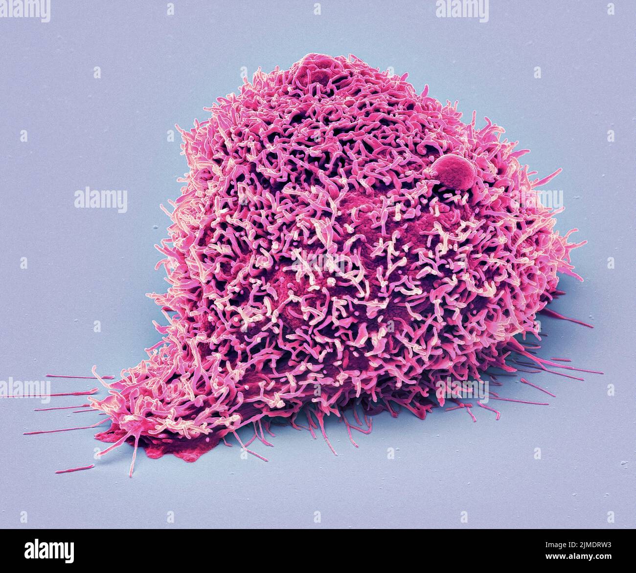 Células cancerosas del riñón, SEM Foto de stock
