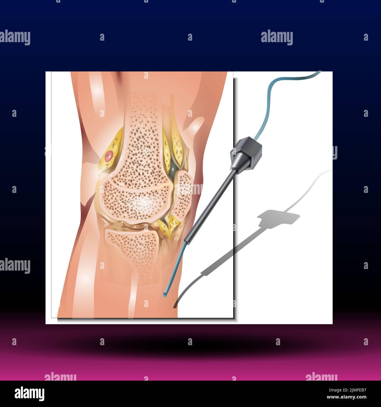 Líquido sinovial de rodilla - cartílago articular, cavidad articular, músculo y tendón, ilustración vectorial aislada Foto de stock