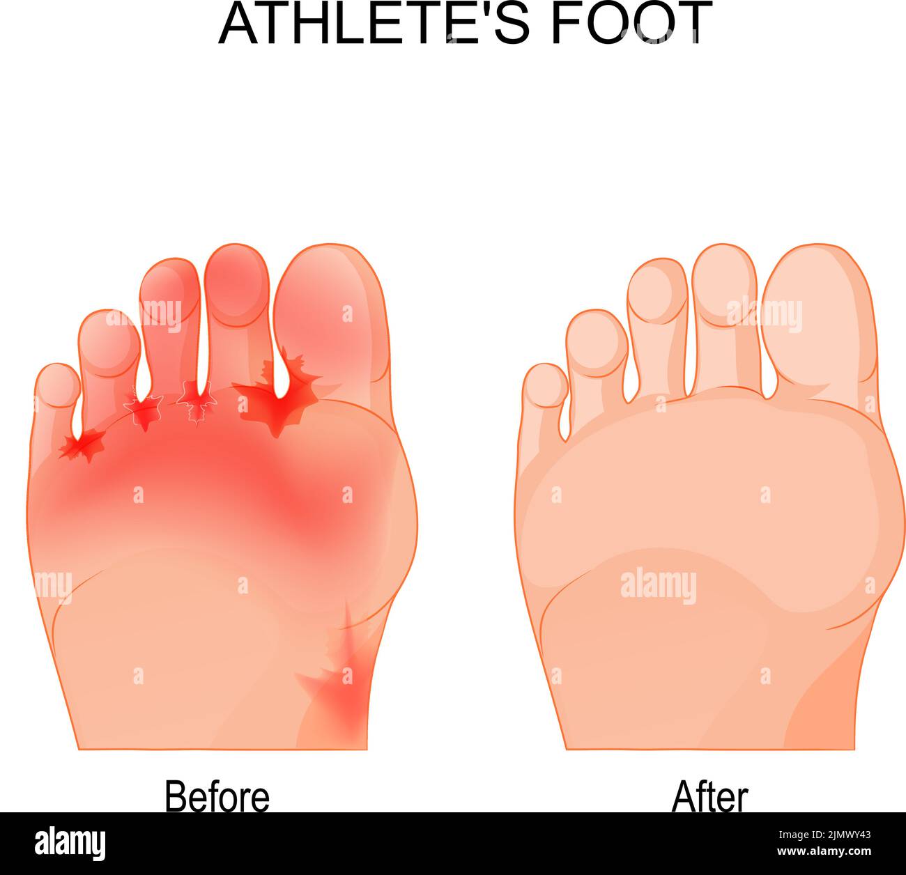 El pie de atleta es una infección micótica que afecta los pies. Comparación y diferencia. Pies humanos antes y después de la terapia. Póster vectorial Ilustración del Vector