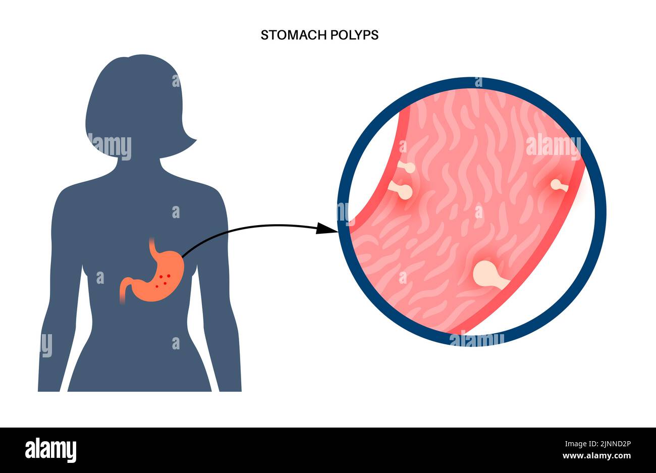 Pólipos estomacales, ilustración. Foto de stock