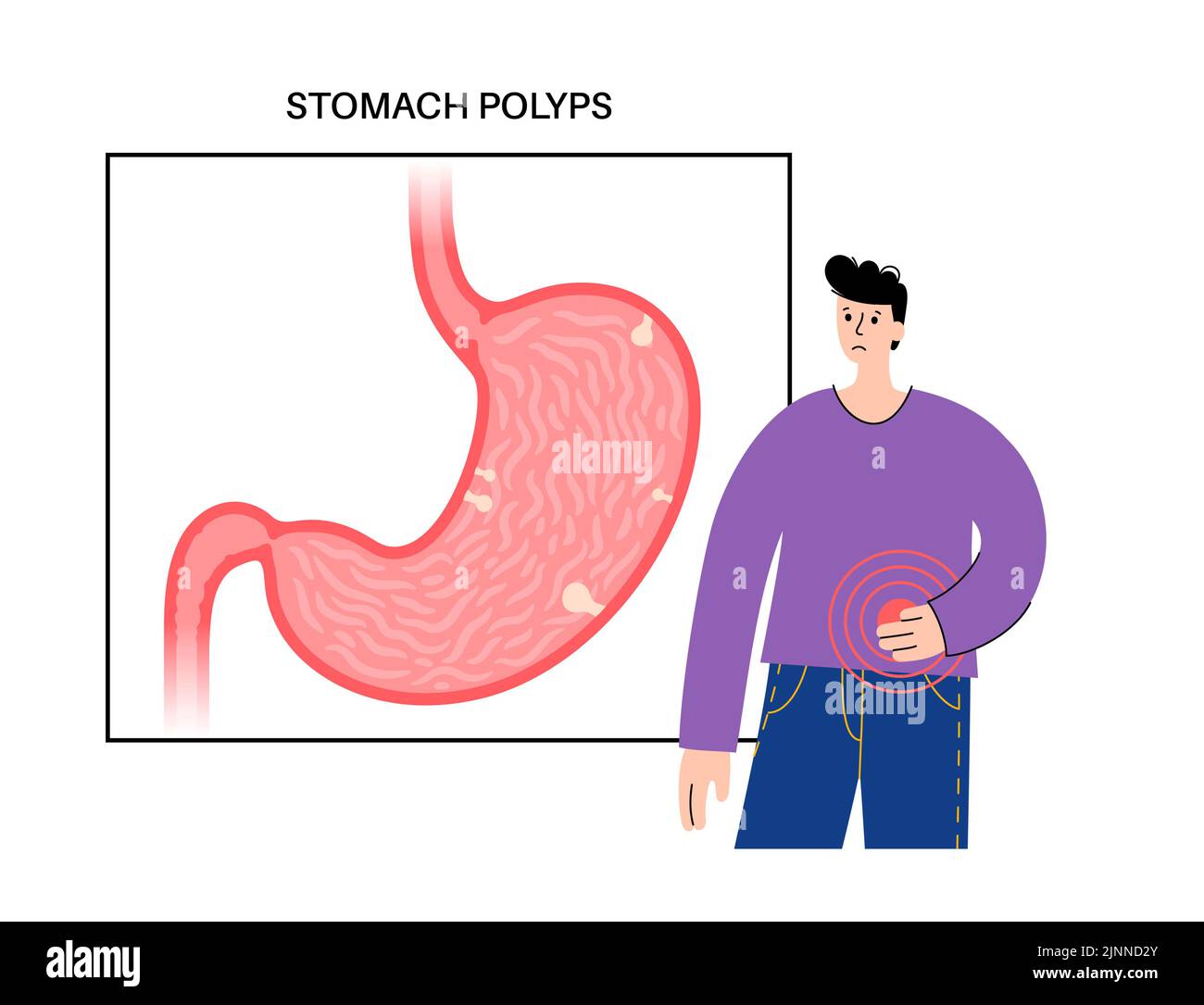 Pólipos estomacales, ilustración. Foto de stock