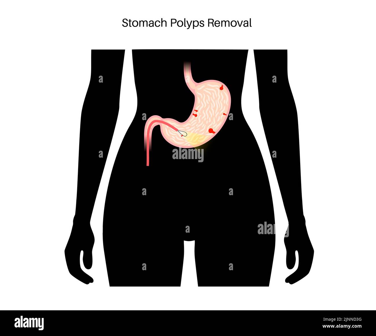 Extracción de pólipos estomacales, ilustración. Foto de stock