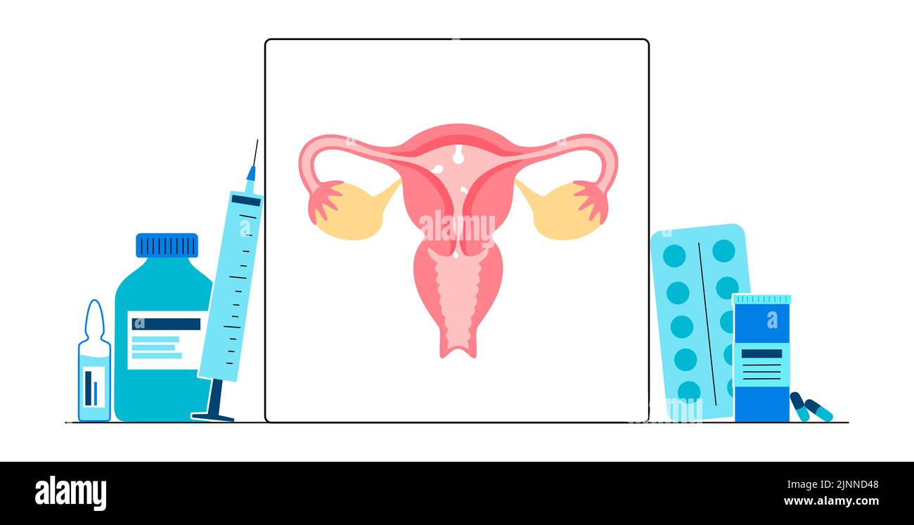 Pólipos uterinos, ilustración. Foto de stock