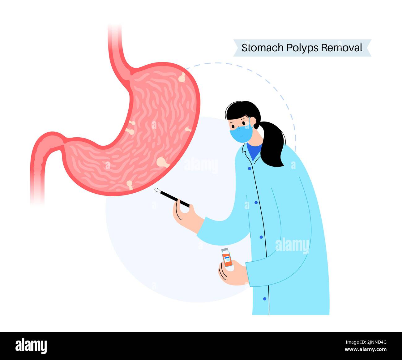 Extracción de pólipos estomacales, ilustración. Foto de stock