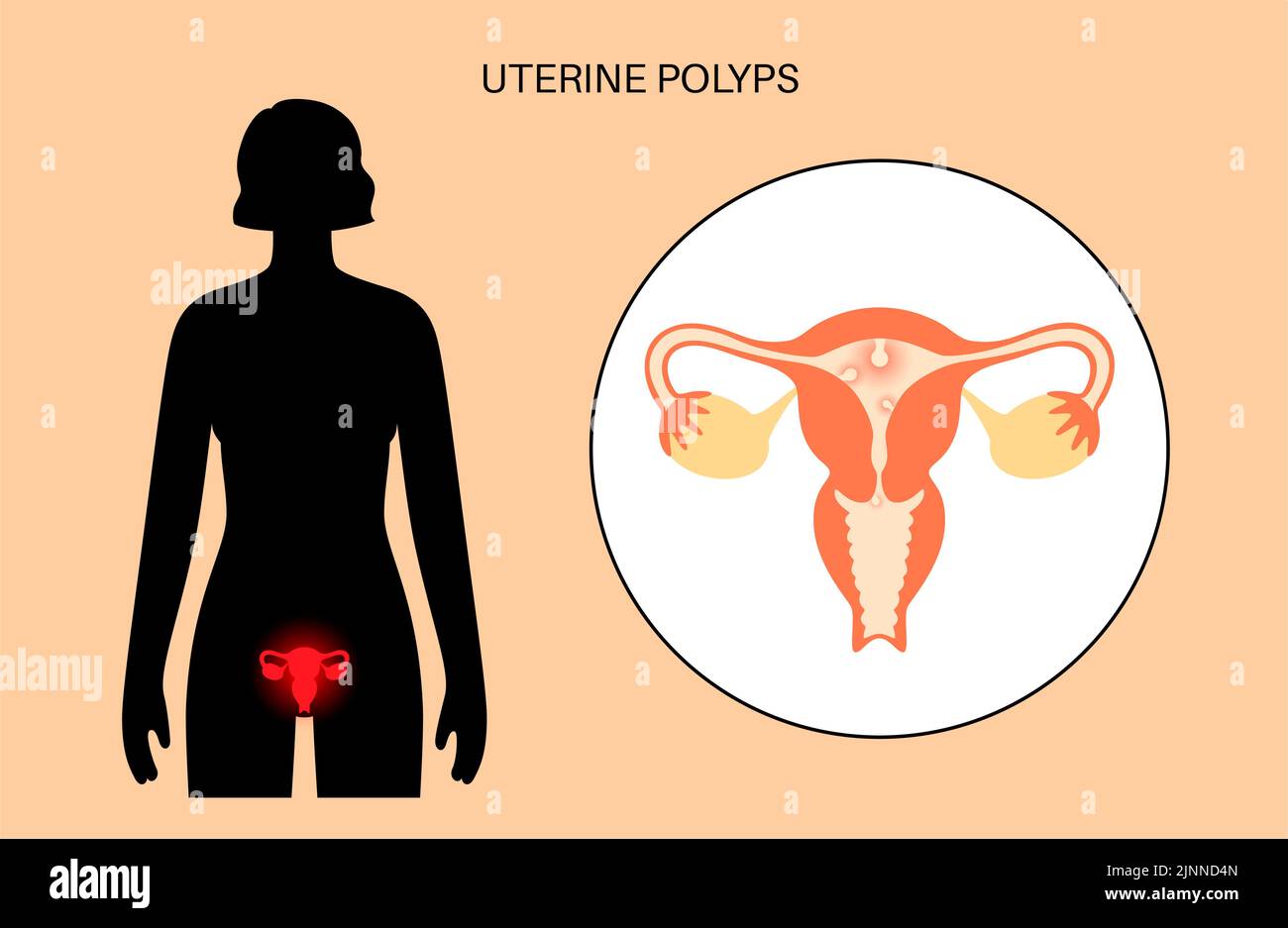 Pólipos uterinos, ilustración. Foto de stock