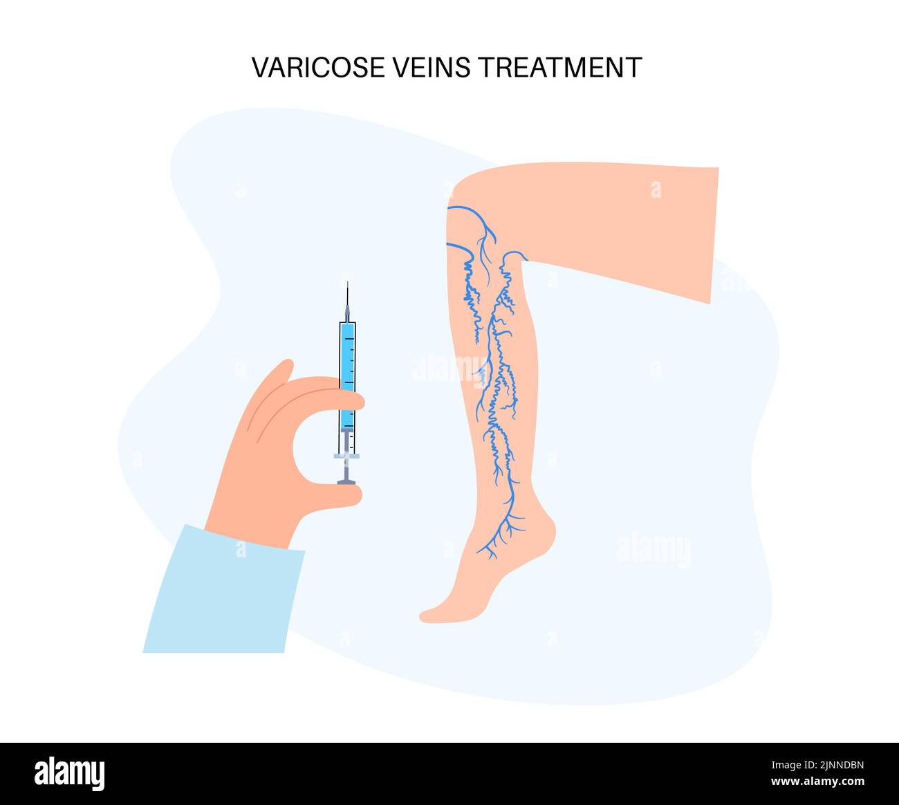 Tratamiento de venas varicosas, ilustración. Foto de stock