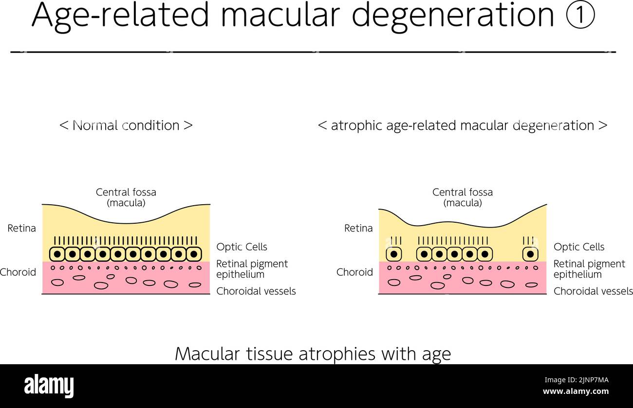 Enfermedad ocular, degeneración macular atrófica relacionada con la edad ilustrada Ilustración del Vector