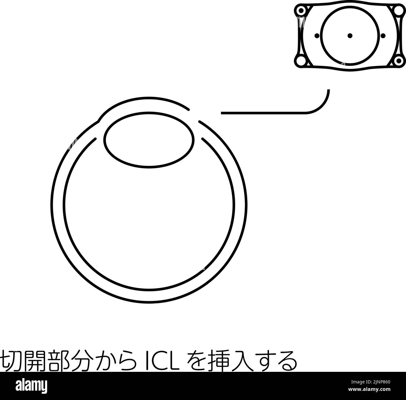 Ilustración de la cirugía de la LCI (lente de contacto intraocular) y ...