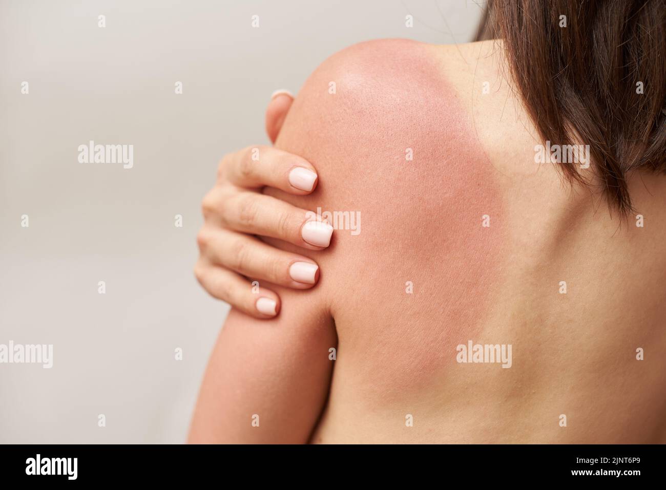 Quemadura de sol en hombro femenino, cuidado de la piel y el concepto de protección. Foto de stock