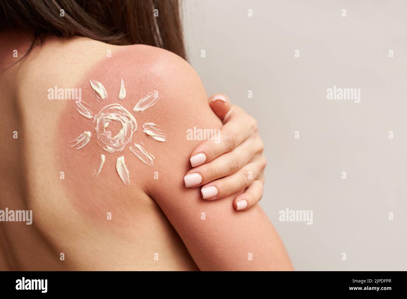 Quemadura de sol en hombro femenino, cuidado de la piel y el concepto de protección. Foto de stock