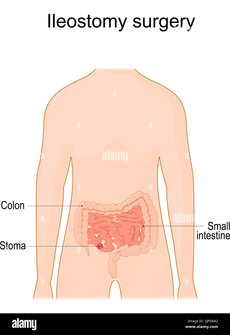 Ileostomía. Estoma. Apertura quirúrgica del intestino delgado, el íleon fuera de la superficie de la piel. Procedimiento quirúrgico. Ilustración vectorial Ilustración del Vector
