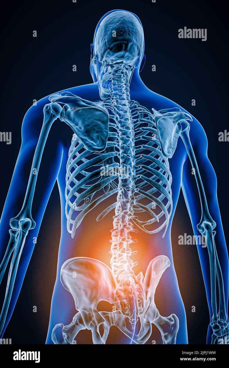 Vista posterior o posterior de la columna vertebral humana o la columna vertebral con inflamación o lesión 3D ilustración. Patología, dolor de columna vertebral, anatomía, lumba Foto de stock