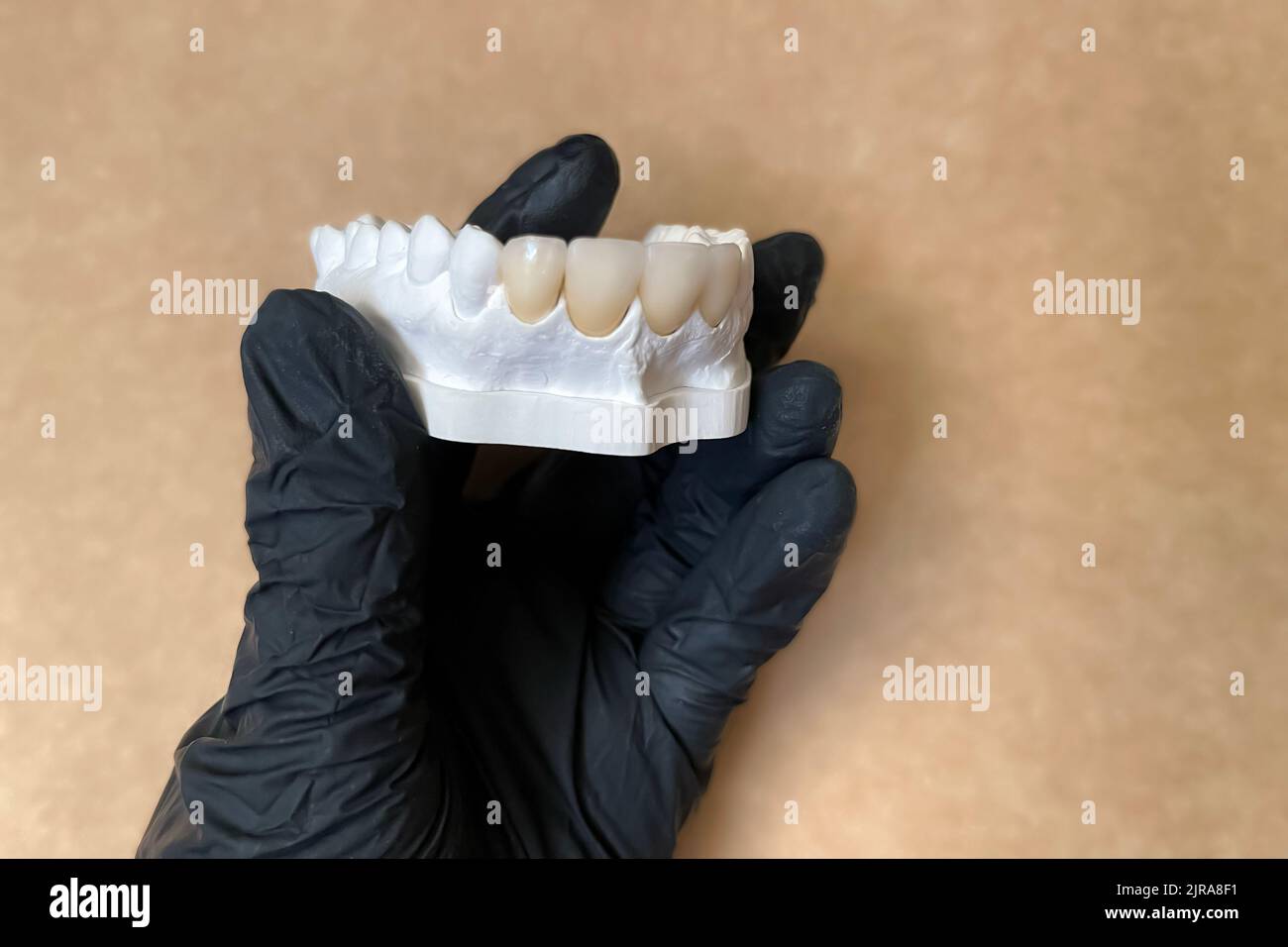 Modelo de yeso con dientes falsos de cerámica o porcelana en la mano del dentista en guante negro. Concepto de prótesis dental y salud dental. Selectivo Foto de stock