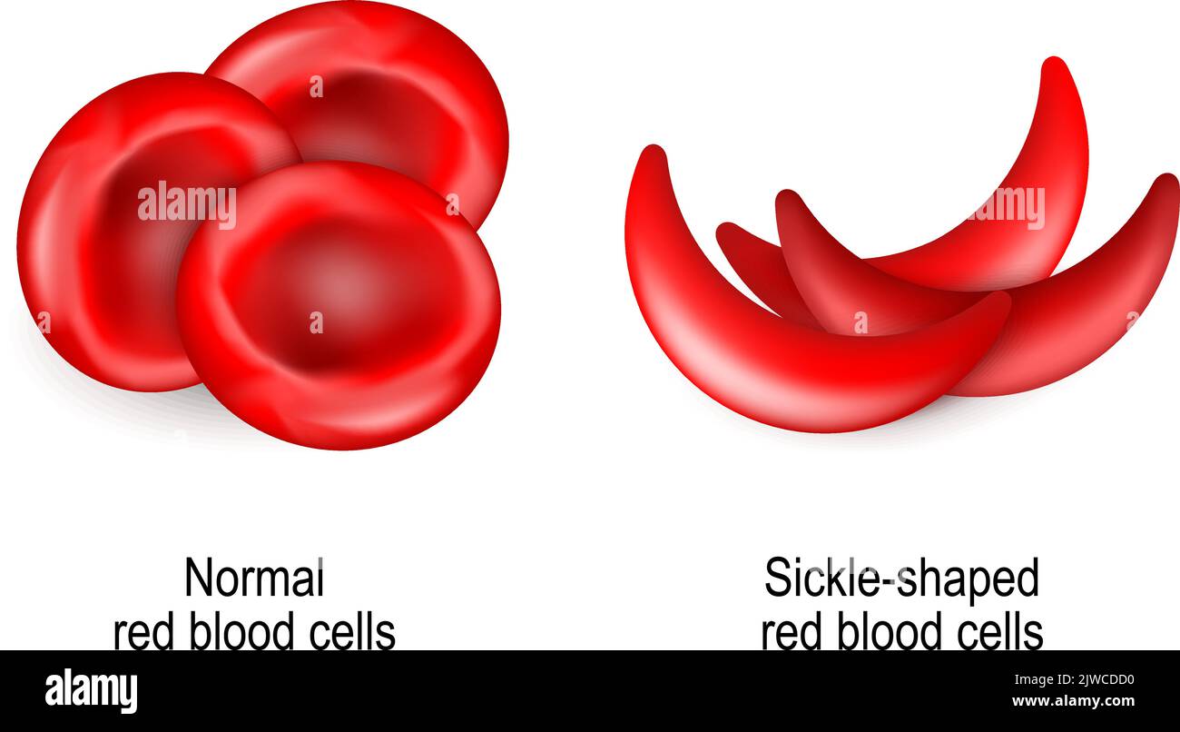 Anemia drepanocítica. La anemia drepanocítica es un trastorno de la sangre heredado de los padres de una persona. Comparación y diferencia Ilustración del Vector