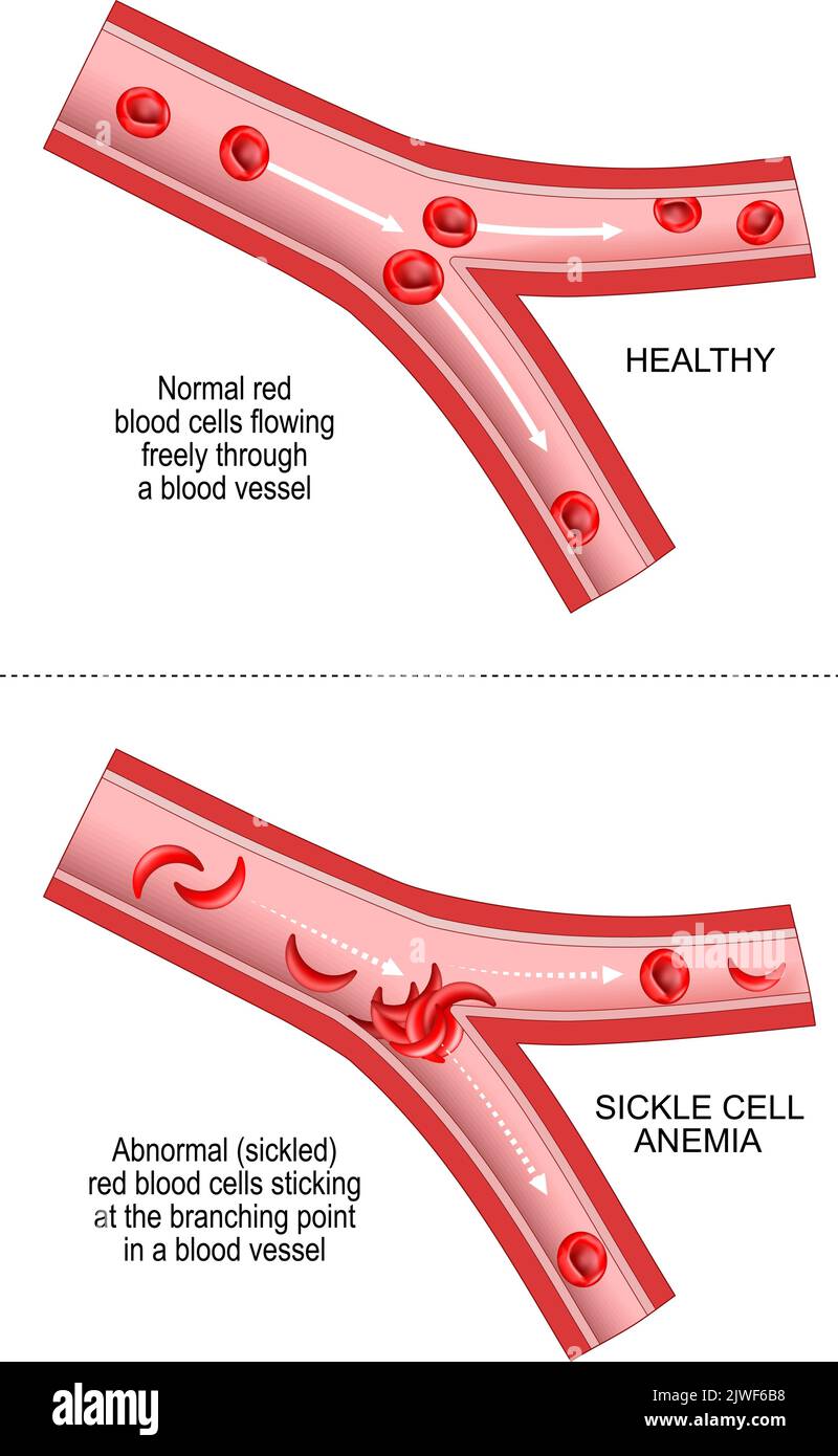Anemia drepanocítica. La anemia drepanocítica es un trastorno hereditario de los padres de una persona. Comparación y diferencia entre vasos sanguíneos Ilustración del Vector
