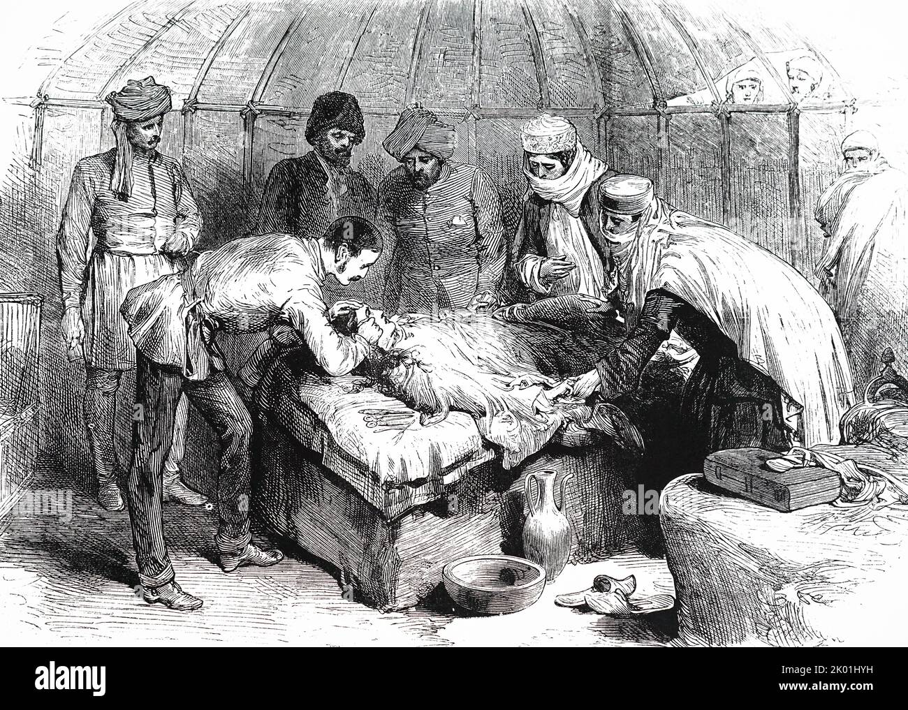 CW Owen, cirujano de la Comisión de Fronteras Afgana, le practicó cirugía plástica a una mujer que había caído en el fuego y le había quemado la cara alrededor del ojo. Paciente bajo cloroformo. De The Illustrated London News, 1885. Foto de stock