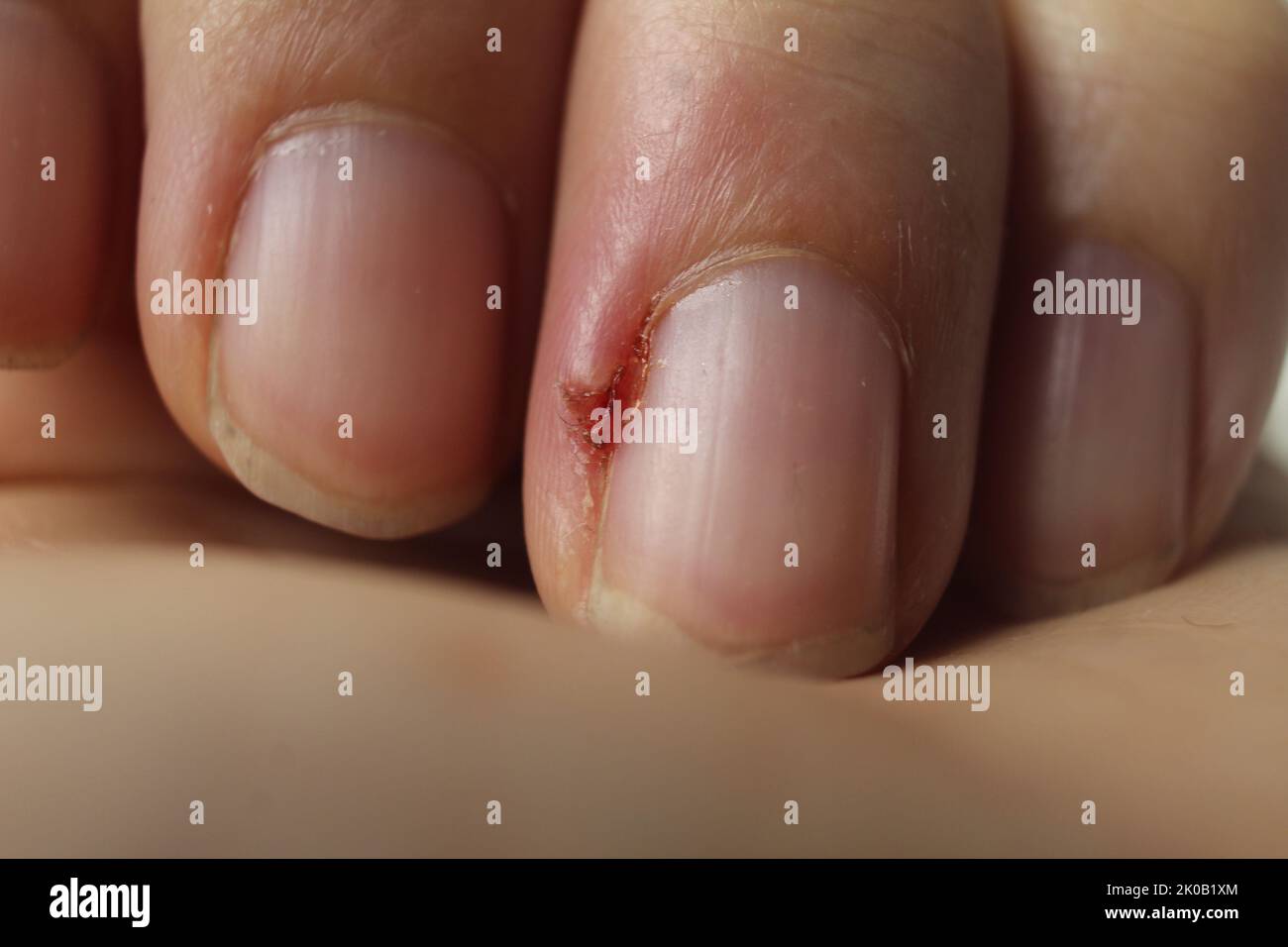 Nail diseases fotografías e imágenes de alta resolución - Alamy