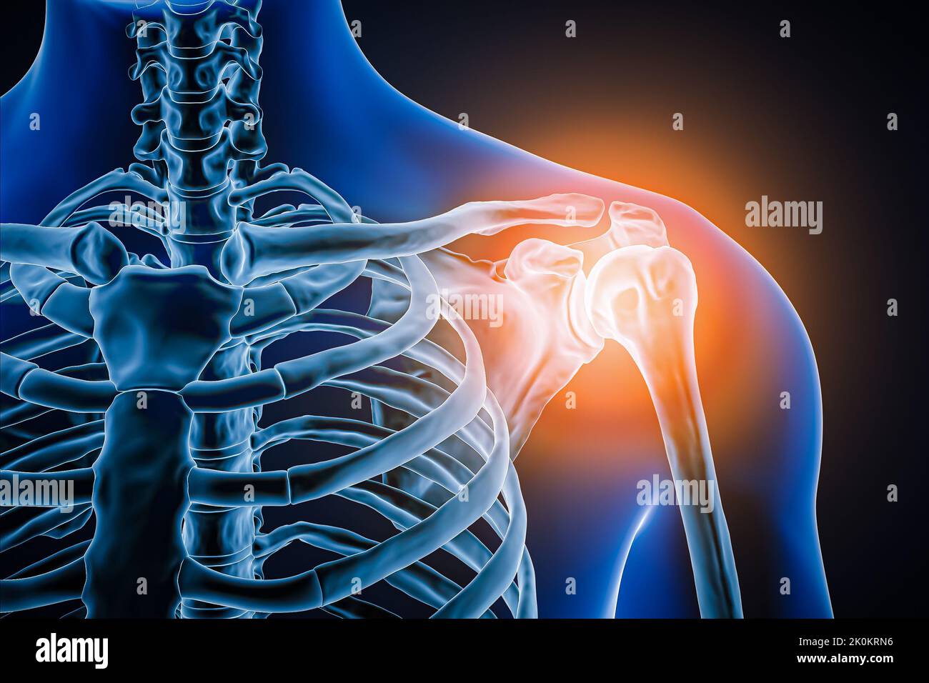 Vista anterior o frontal de la articulación del hombro humano y los huesos con inflamación 3D ilustración. Patología, dolor articular, anatomía, osteología, r Foto de stock
