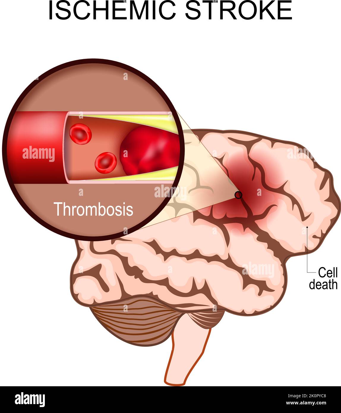 accidente cerebrovascular isquémico. Cerebro humano. Primer plano de un coágulo de sangre en una arteria que provoca la muerte cerebral en el área afectada. Trombosis. Infarto cerebral Ilustración del Vector