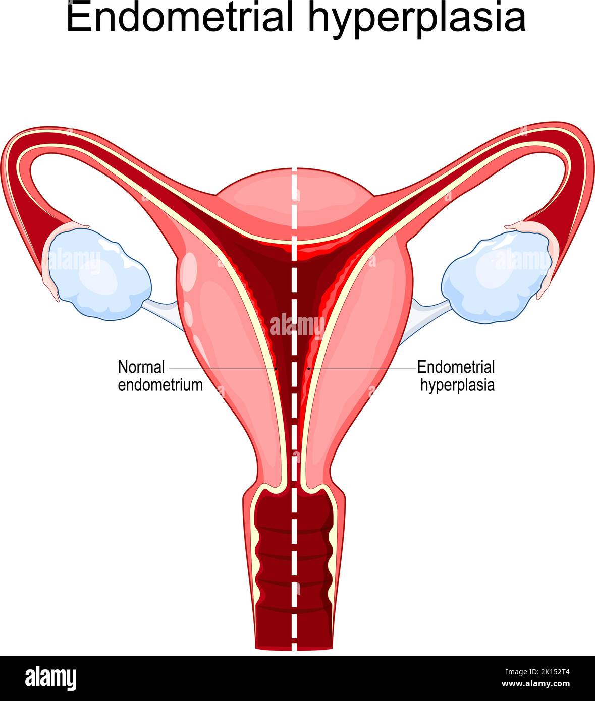 Hiperplasia endometrial Comparación del útero con el endometrio normal y proliferación excesiva de las células del revestimiento interno del útero. Mujer Ilustración del Vector