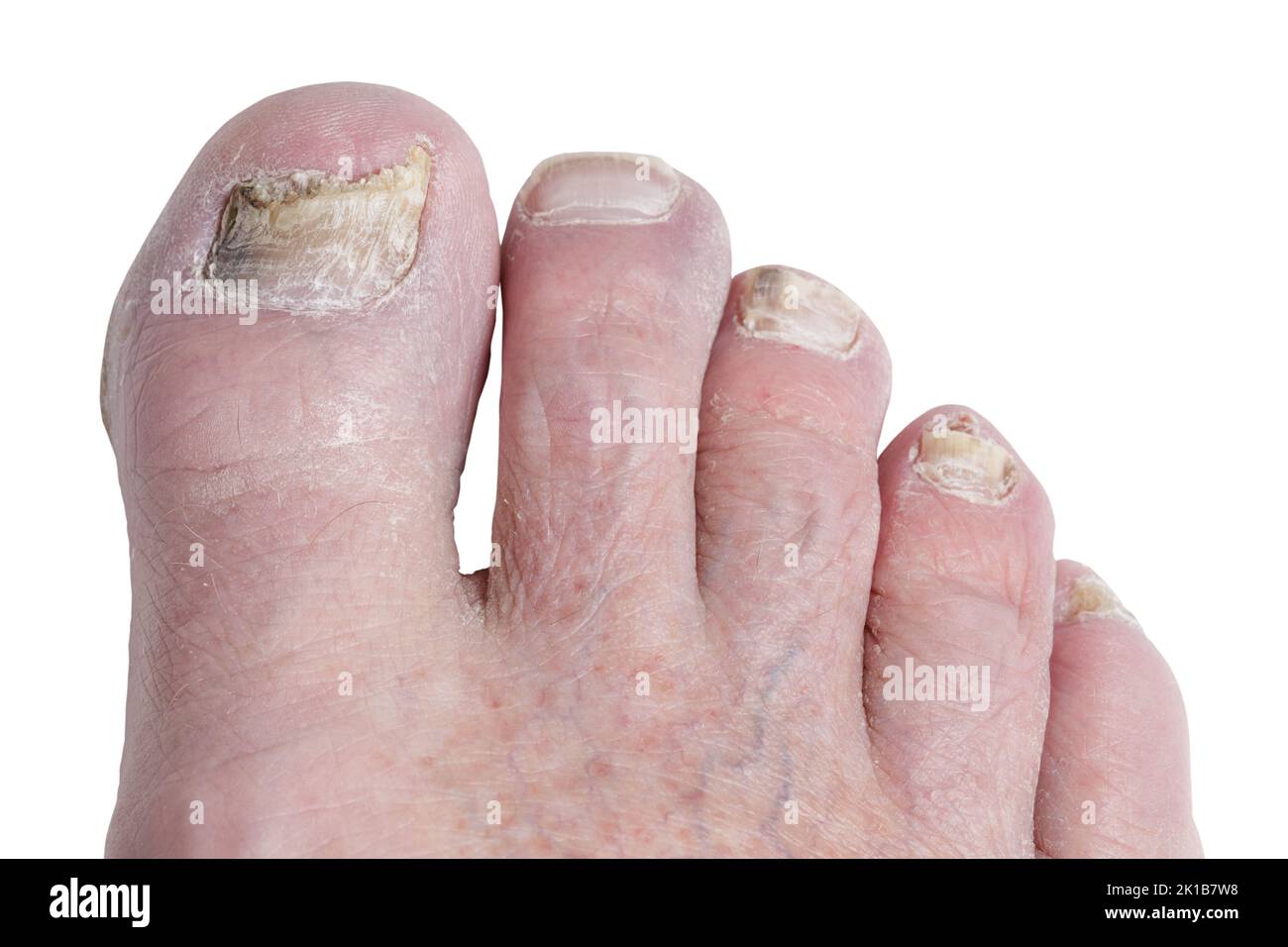 Primer plano de un anciano pie masculino suffering un caso malo de