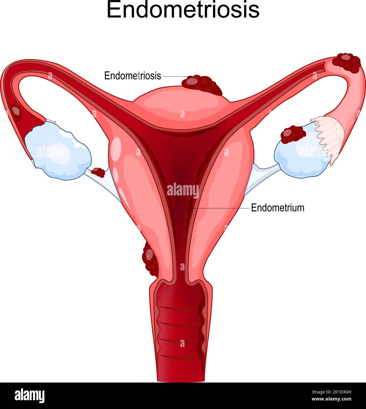 Endometriosis. Sistema reproductor femenino. Útero humano con células endometrio que crecen fuera del útero. Enfermedades femeninas. Póster de vectores Ilustración del Vector