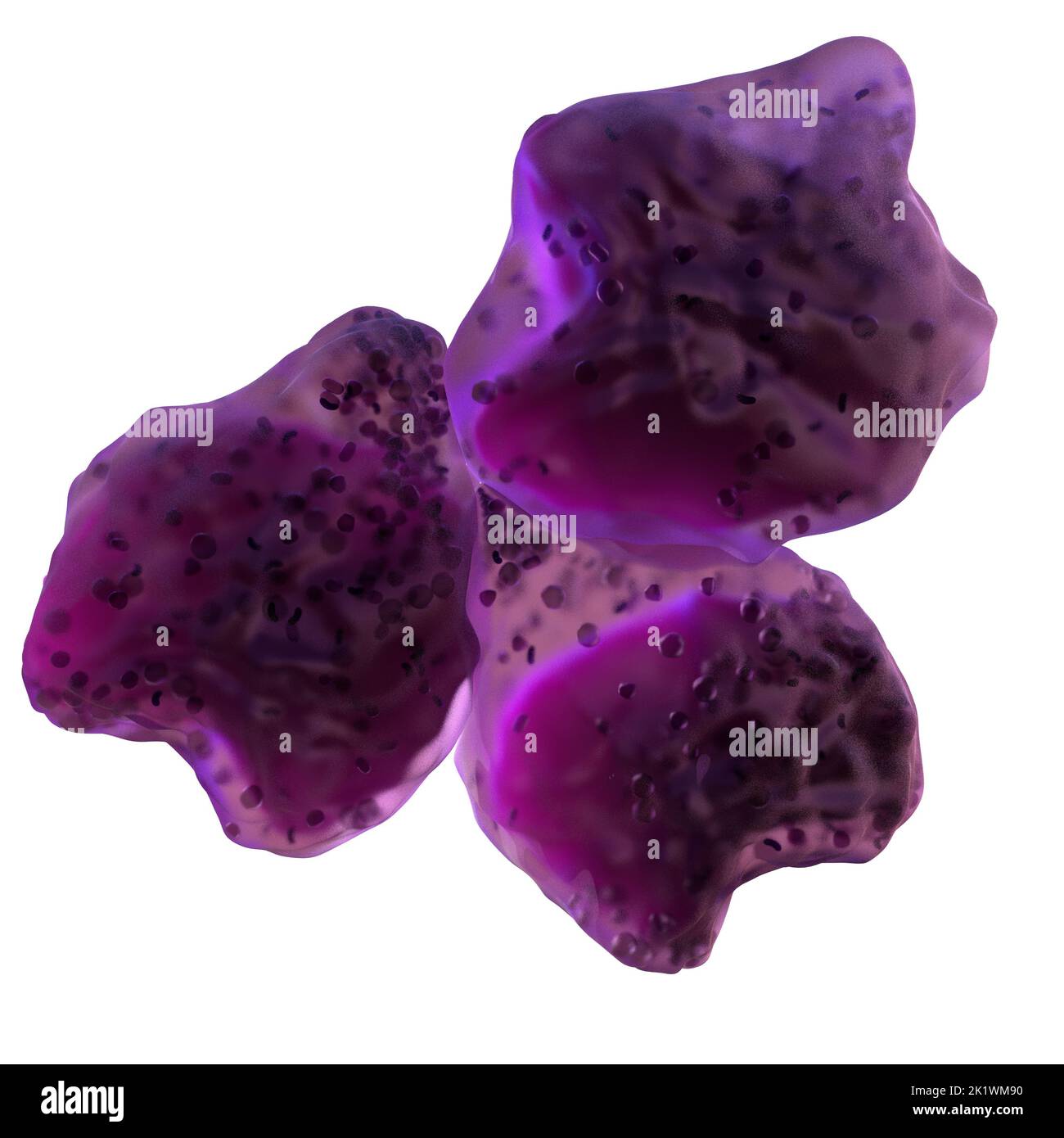 Linfoma difuso de células B grandes, ilustración Fotografía de stock