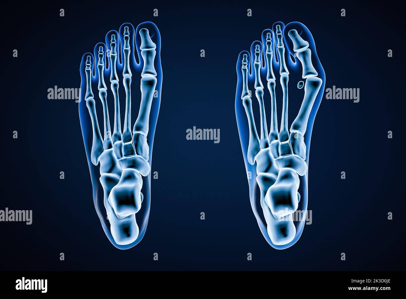 Ilustración de representación de rayos X 3D Hallux Valgus o bunion. Vista dorsal o superior del pie izquierdo humano sano y herido sobre fondo azul. Anatomía, osteol Foto de stock