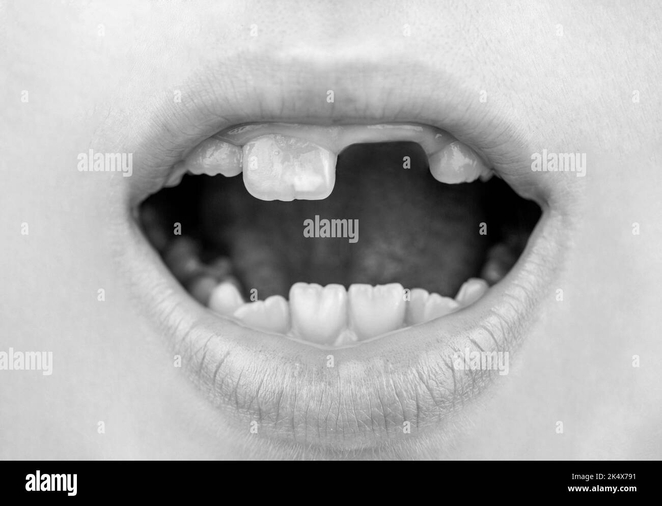 Primer plano de dentición infantil poco saludable. Boca abierta del paciente de niño mostrando caries dentales. Blanco y negro Foto de stock