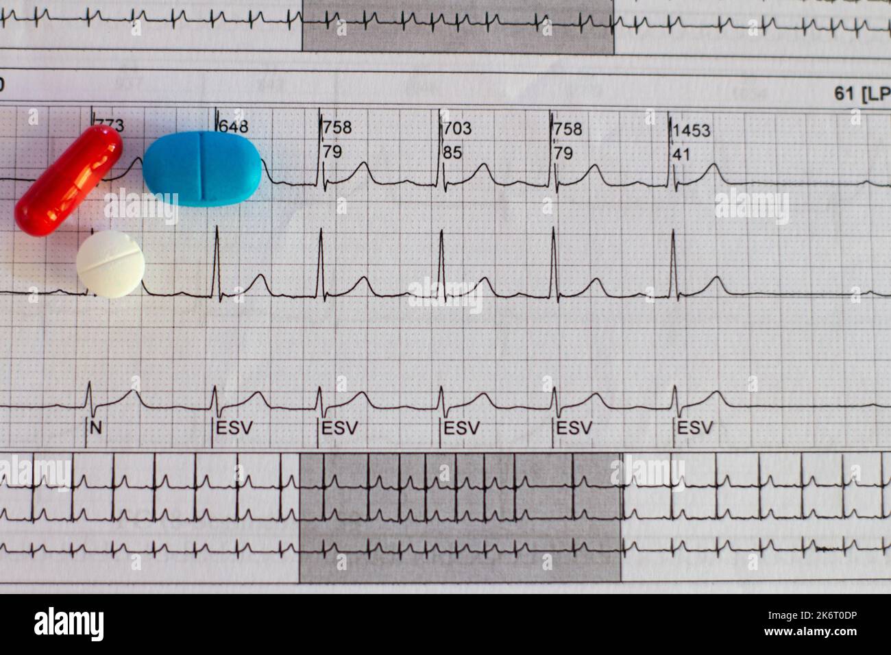 Electrocardiograma Mostrando Taquicardia Supraventricular Y Pastillas Coloreadas Concepto De