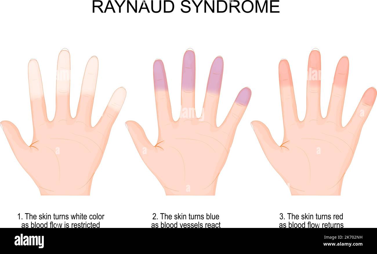 Síndrome de Raynaud. Manos de una persona con fenómeno de Raynaud durante un ataque de color blanco cuando el flujo sanguíneo se restringe a azul y rojo Ilustración del Vector