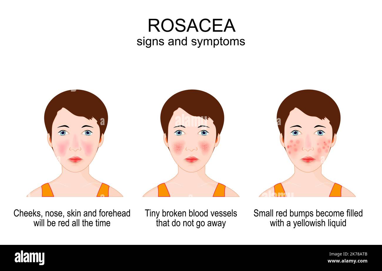 Rosácea. Signos y síntomas de la rosácea acné en la cara de una mujer joven. Condición de la piel por enrojecimiento, espinillas, hinchazón y pequeños vasos sanguíneos rotos Ilustración del Vector